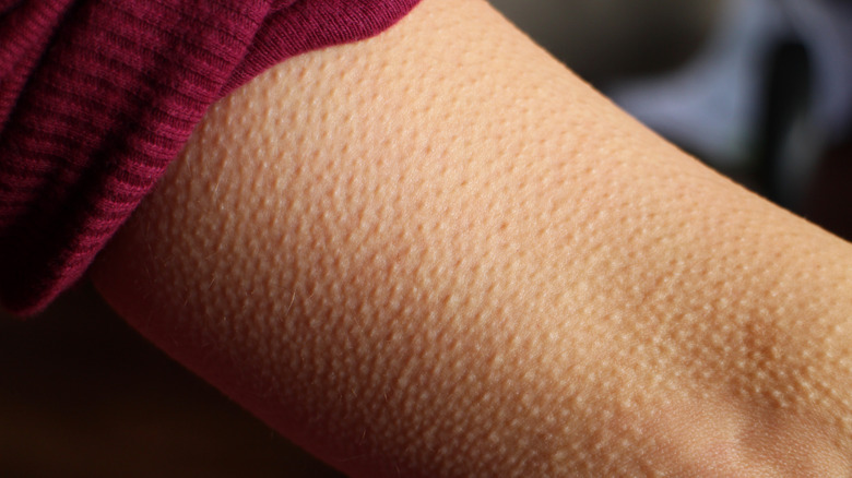 A closeup shot of a persons arms with goosebumps visible on their skin