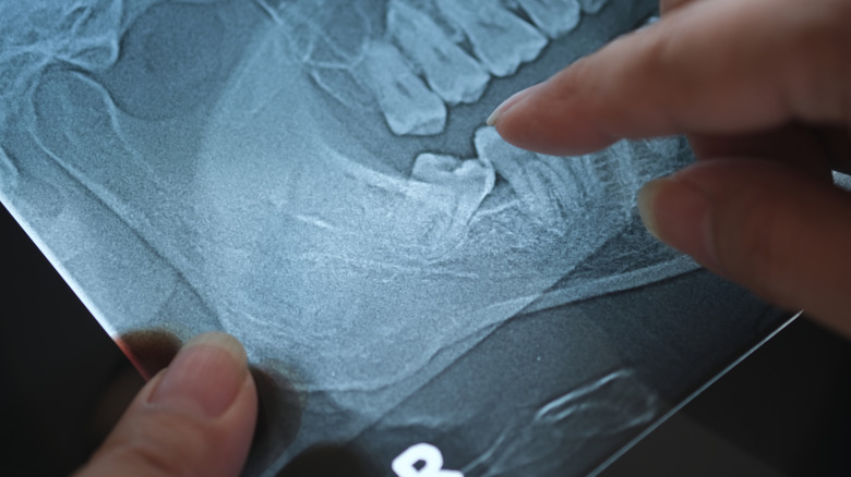 Fingers point to wisdom tooth impaction on blue X-ray