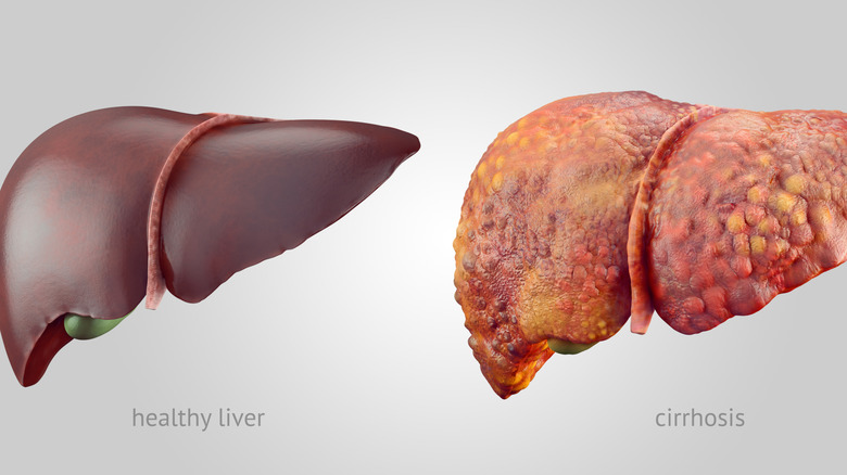 Healthy liver imaged next to liver with cirrhosis, scarred and bumpy