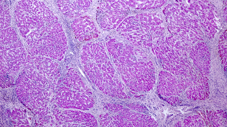 Microscopic cross section of liver cells, pinks cells with fatty pathways dividing them
