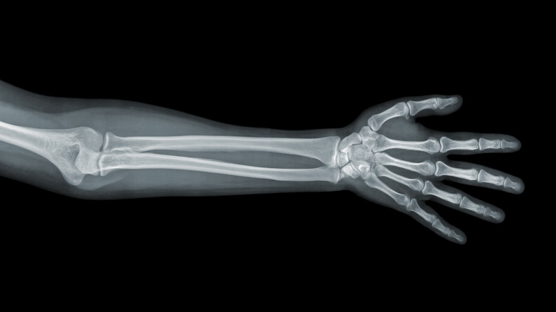 Xray view of hand and lower arm with black background