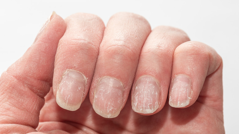 Hand with brittle, peeling nails