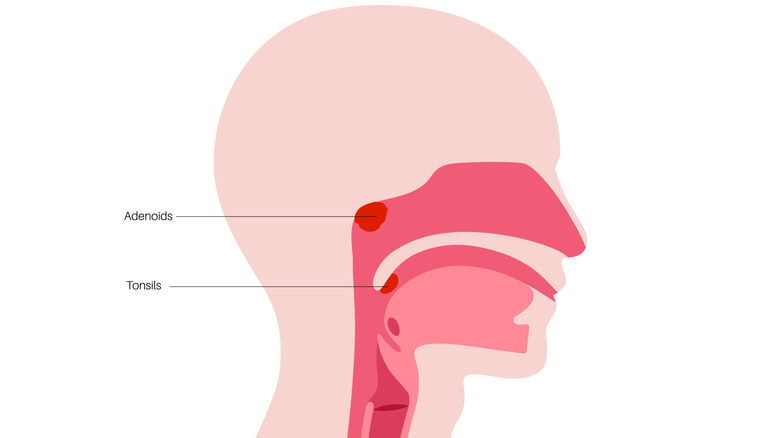 Anatomic illustration pointing to where the adenoids and tonsils are located in the throat