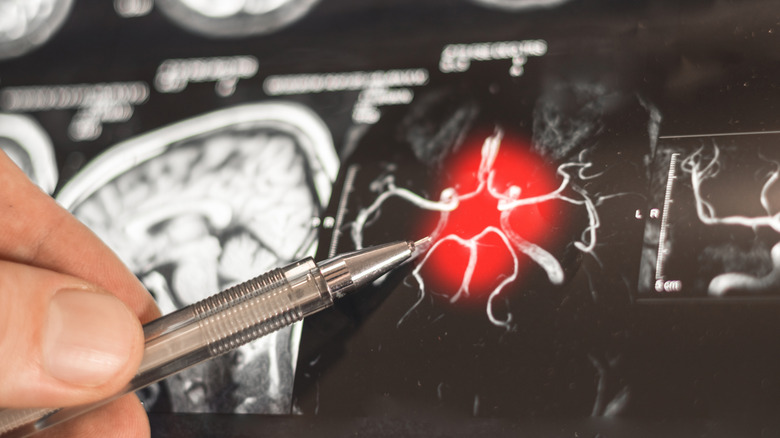Close-up shot of brain scan, doctor pointing to activity with metal pen