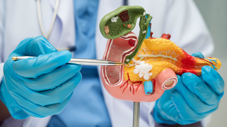 Doctor pointing to 3D model of bile duct, gallbladder, and damaged pancreas