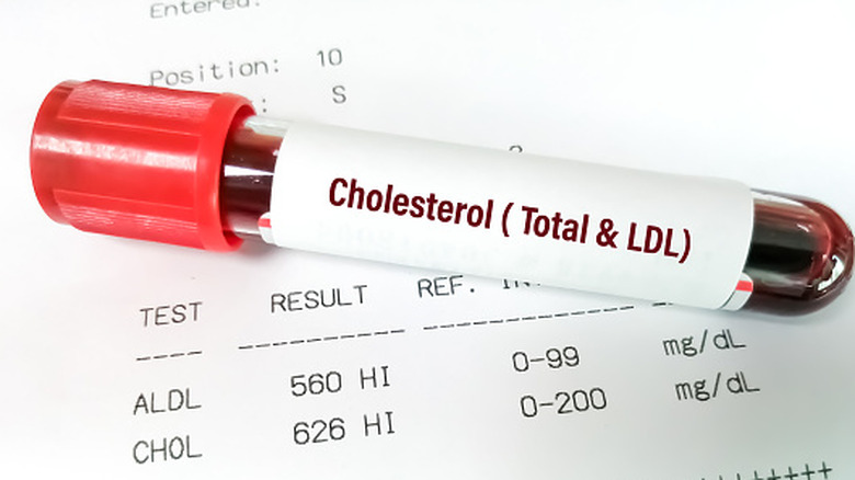 Blood sample on top of paper with lab results