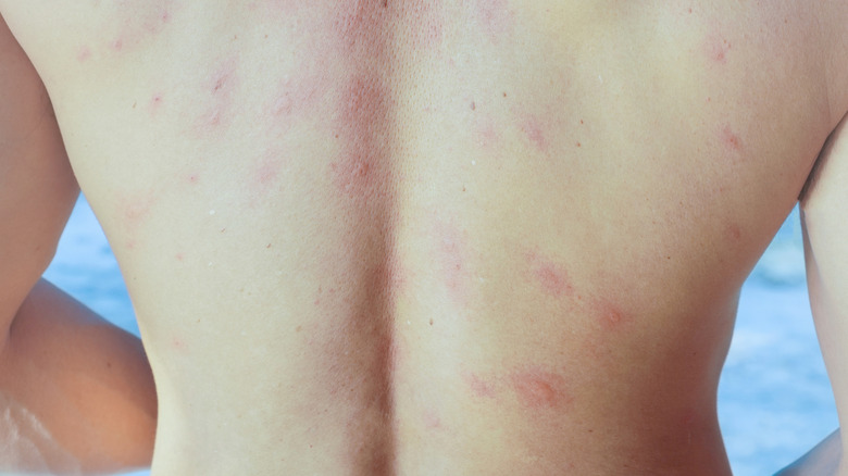 Sea lice rash, or seabather's eruption, on a person's back while they're at the beach