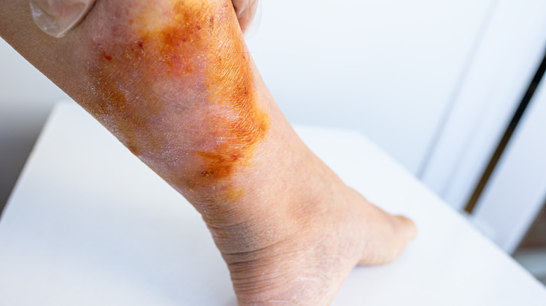 Several jellyfish stings on a person's leg