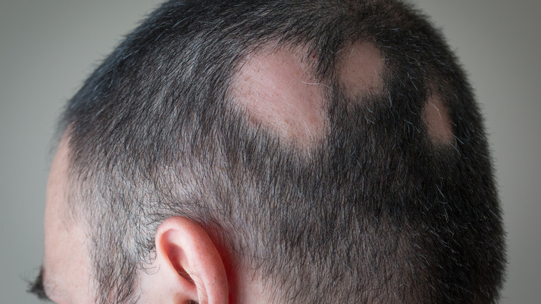 Man with bald spots on head due to alopeica areata