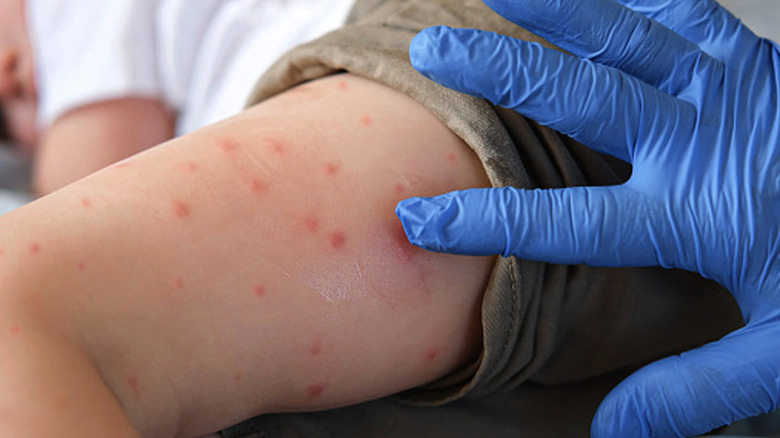 Hand in blue glove probes an arm with a red rash, red bumps