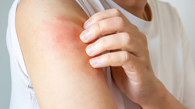 A person scratching their arm which is red and irritated.