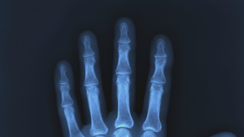 X-ray image of a hand