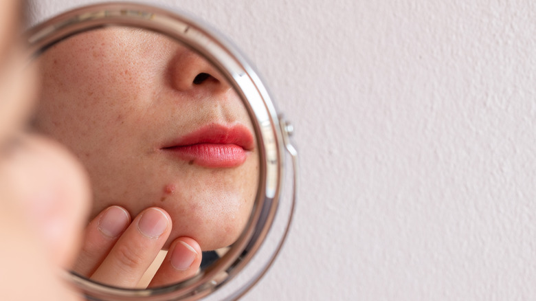 Woman's face in mirror with fingers next to acne lesion
