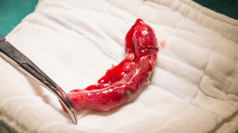 Close-up of an inflamed appendix with a surgical tool on a towel after removal