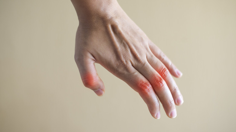 Hand joints affected by rheumatoid arthritis