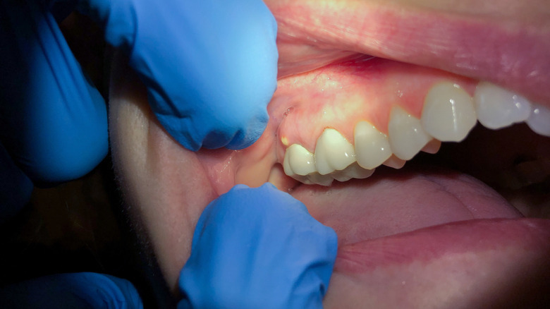 Dentist examining an abscess near a person's molars